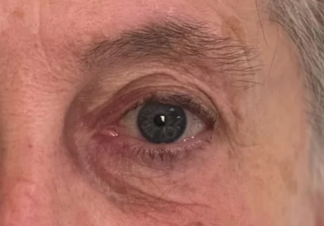 Gros plan d'un oeil creux apres une premiere blepharoplastie