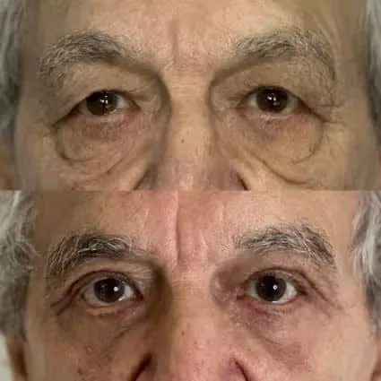 Avant et après : Chez ce patient, le challenge était d’obtenir un résultat naturel et s