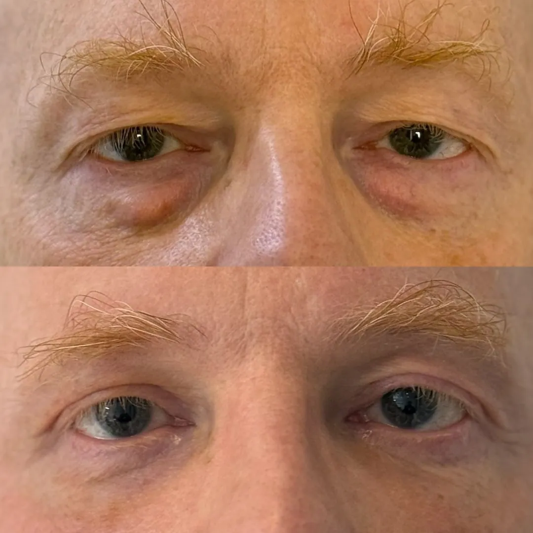 Blepharoplasty Before Operation + poches sous les yeux, blépharoplastie supérieure