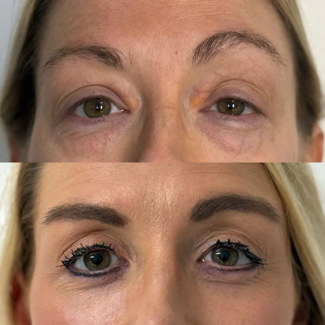 Sculpter le regard avec une blépharoplastie d'addition