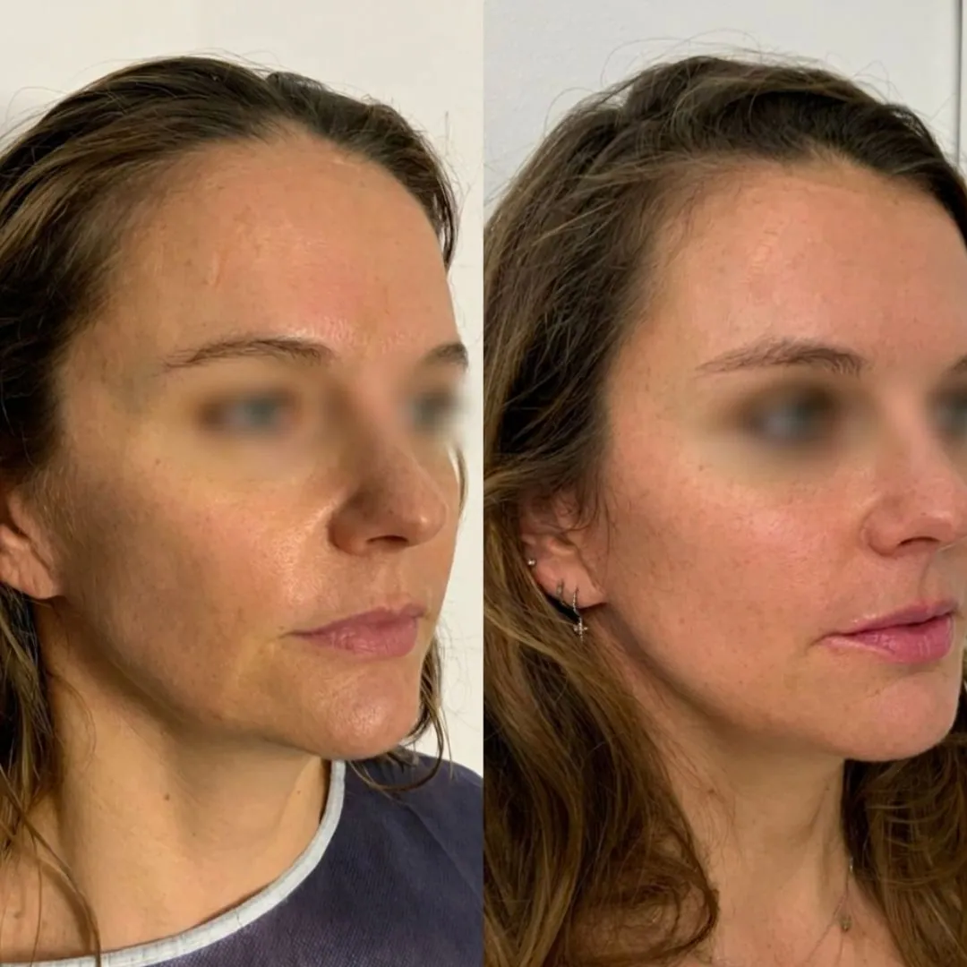 Micro Injections de graisse