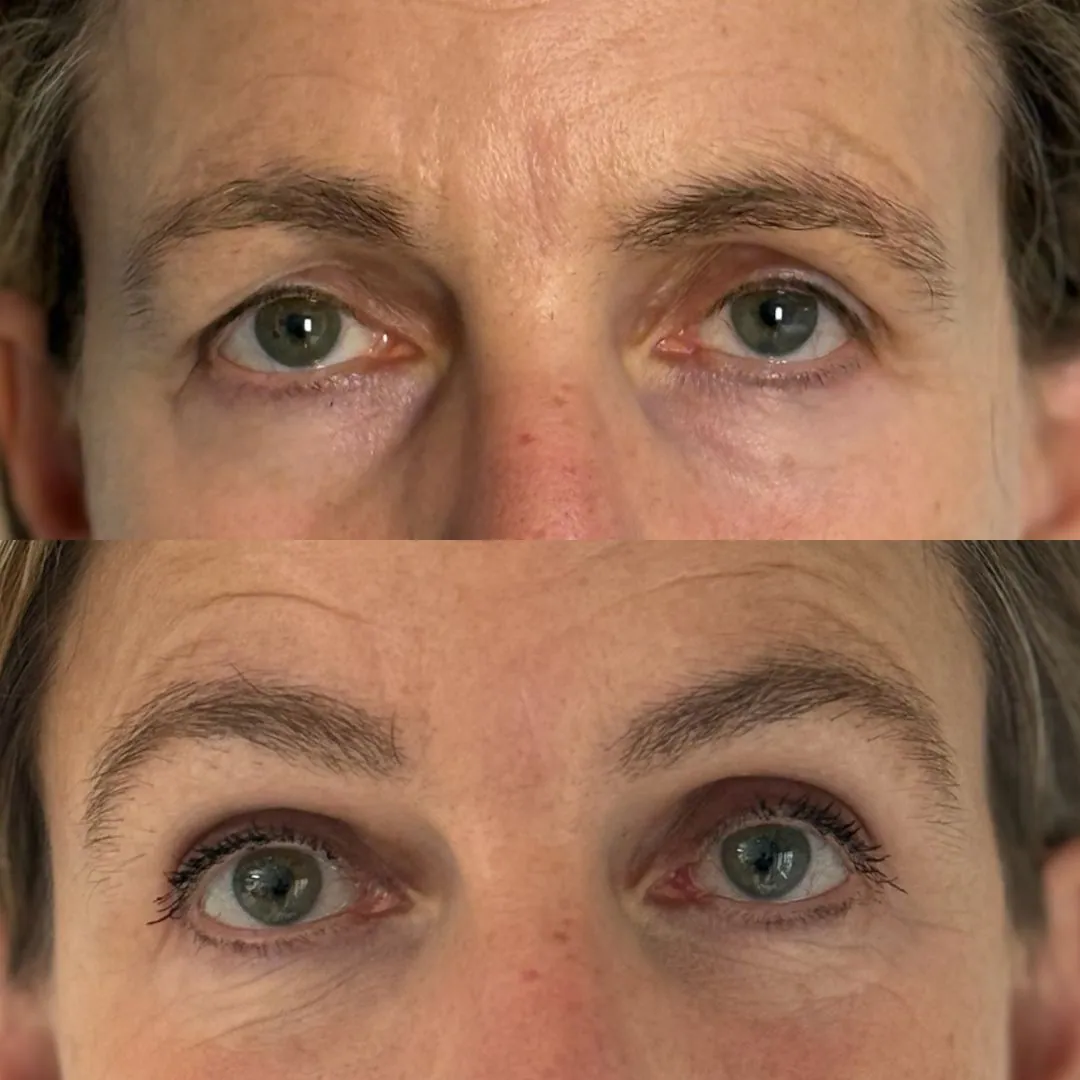 Ptosis bilatérale et injection de graisse