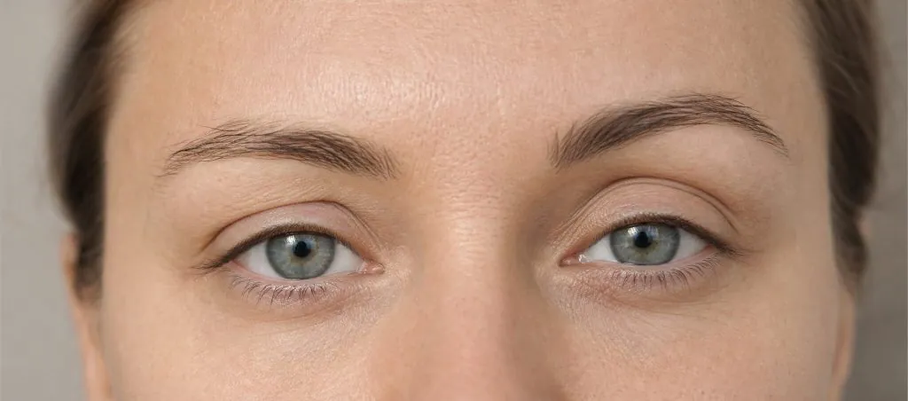 Regard de face présentant une asymétrie subtile des paupières supérieures