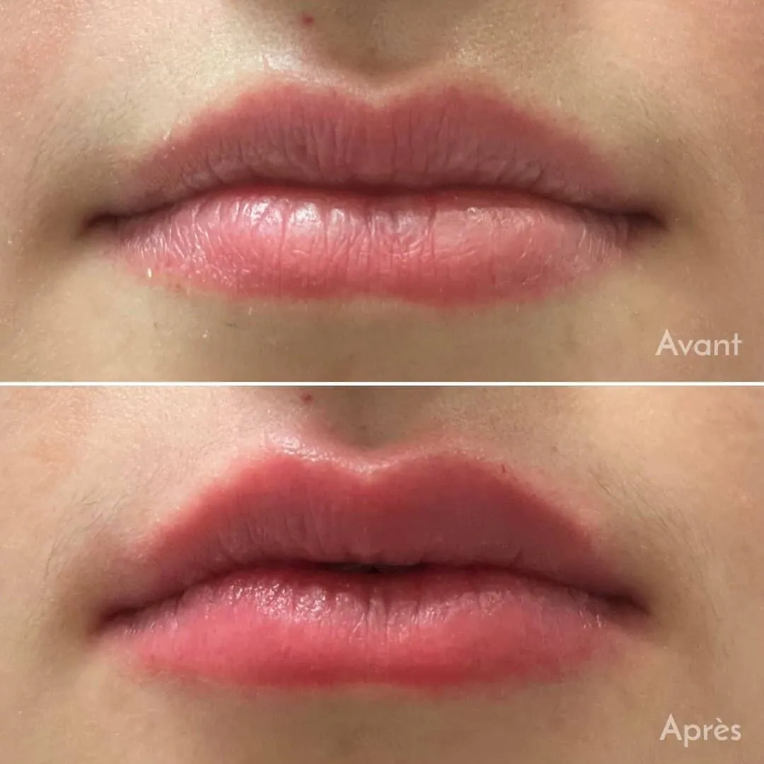 Avant et après : Injections lèvres à l’acide hyaluronique