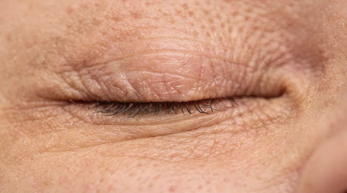 chirurgie ptosis mullerectomie paris