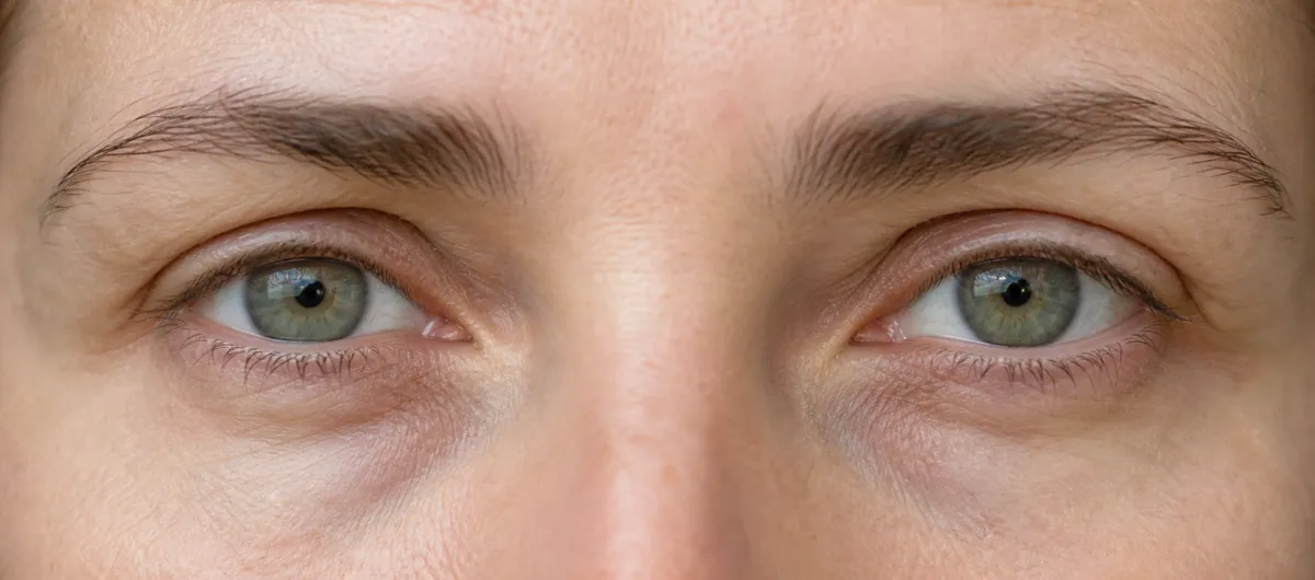 Regard et cernes creux après perte de poids, sans visage complet ni outil médical
