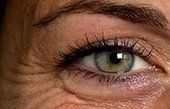– Docteur Bernard Hayot Blepharoplasty: Aesthetic eyelid surgery