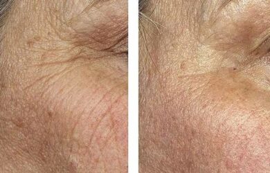 How to eliminate wrinkles with lasers and without surgery?