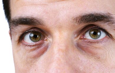 Treatment of drooping eyelids