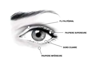 Why don’t I have a conventional lower blepharoplasty and what are the risks?