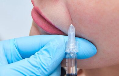 Microlipofilling of the nasolabial folds