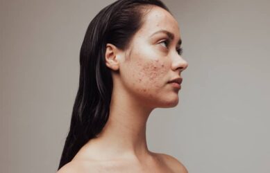 What are the symptoms of a bad Botox reaction?