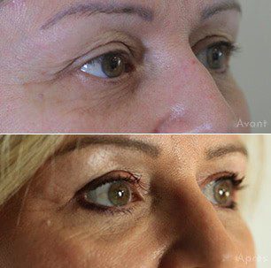avant-apres-1-blepharoplastie-dr-hayot avant-apres- blépharoplastie dr hayot