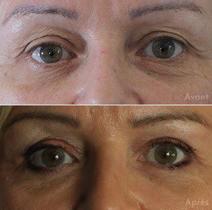 avant-apres-pinch-blepharoplastie avant-apres-pinch-blepharoplastie
