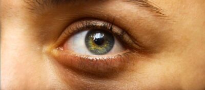 Blépharoplastie à Paris : Guide Complet 2026 pour un Regard Rajeuni Naturellement