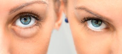 Oculoplasticien Paris : Expertise médicale pour la chirurgie du regard