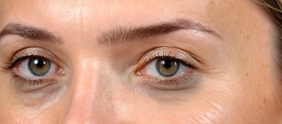 L’acide hyaluronique dans le cerne : pourquoi j’ai arrêté d’en injecter