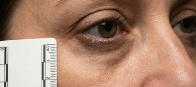 – Docteur Bernard Hayot Blépharoplastie hybride laser nanofat : révolution 4D de la chirurgie des paupières