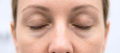 – Docteur Bernard Hayot Blépharoplastie Réparatrice Après Injections Ratées à Paris