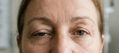 – Docteur Bernard Hayot Eyelid Ptosis: Understanding the Causes and Finding the Right Treatment: Complete Guide