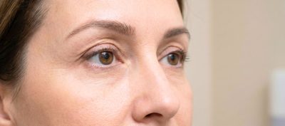 Médecine esthétique ou chirurgie des paupières : comment choisir selon l’âge pour prévenir le vieillissement du regard ?