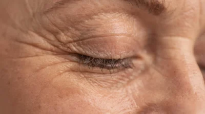 – Docteur Bernard Hayot Recovery after blepharoplasty: what to really expect: Complete Guide
