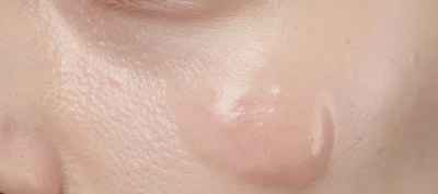– Docteur Bernard Hayot Persistent Edema After Blepharoplasty: Technique, Results and Postoperative Course: Complete Guide